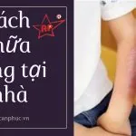 Mẹo chữa vết bỏng hiệu quả từ những nguyên liệu có sẵn trong bếp